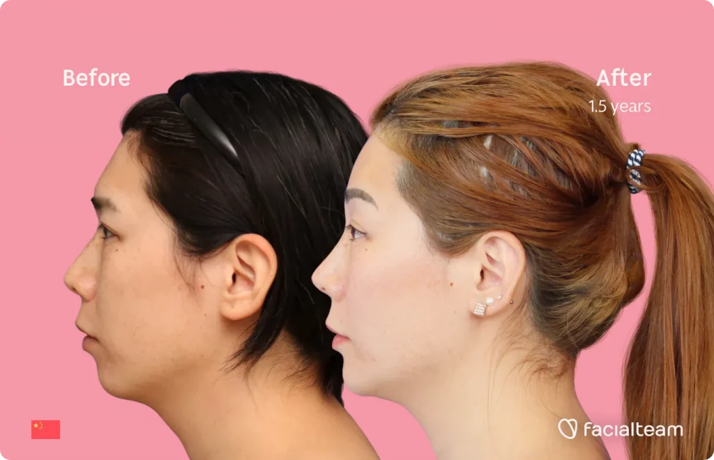 Das linke Bild der FFS-Patientin Harriet zeigt die Ergebnisse vor und nach der Feminisierungsoperation im Gesicht mit Facialteam, bestehend aus Stirn, Kiefer und Kinn, Rhinoplastik und Feminisierungsoperation.