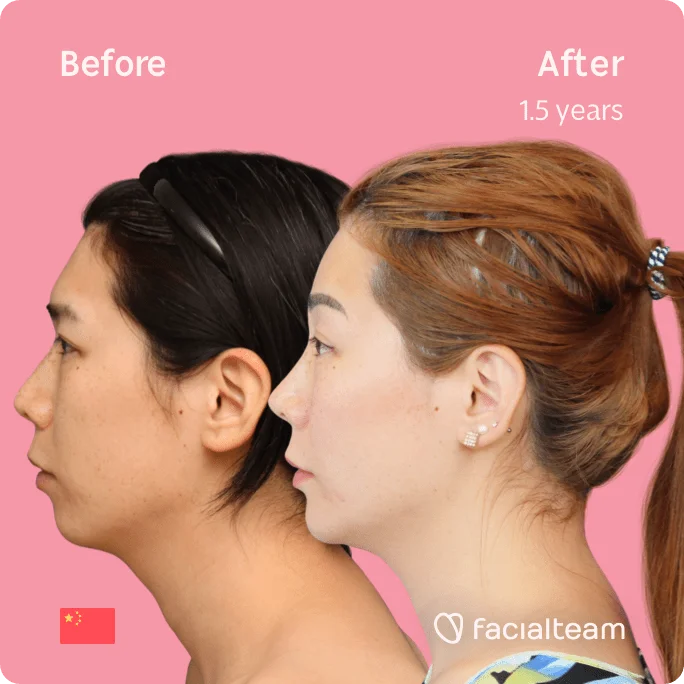 Quadratisches Bild der FFS-Patientin Harriet auf der linken Seite, das die Ergebnisse vor und nach der Feminisierungsoperation des Gesichts mit Facialteam, bestehend aus Stirn, Kiefer und Kinn, sowie der Feminisierungsoperation der Rhinoplastik zeigt.