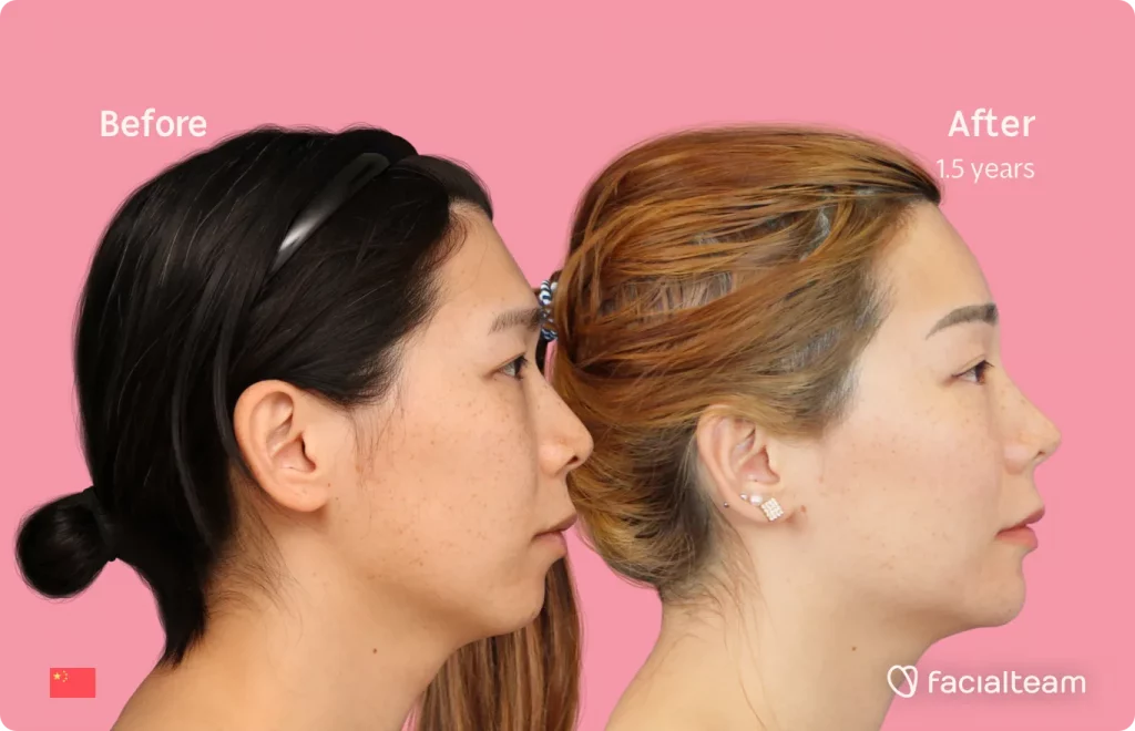Seitenbild der FFS-Patientin Harriet, das die Ergebnisse vor und nach der Feminisierungsoperation des Gesichts mit Facialteam, bestehend aus Stirn, Kiefer und Kinn, sowie der Feminisierungsoperation der Rhinoplastik zeigt.