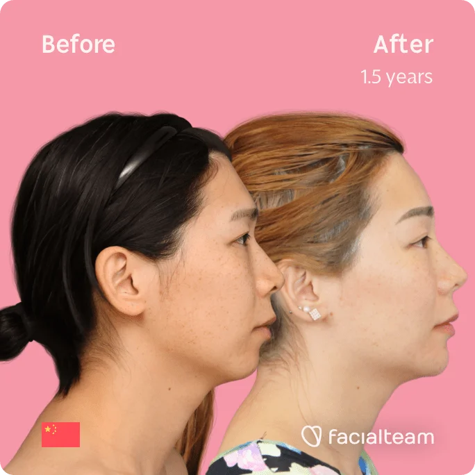 Quadratisches Seitenbild der FFS-Patientin Harriet, das die Ergebnisse vor und nach der Feminisierungsoperation des Gesichts mit Facialteam, bestehend aus Stirn, Kiefer und Kinn, sowie der Feminisierungsoperation der Rhinoplastik zeigt.