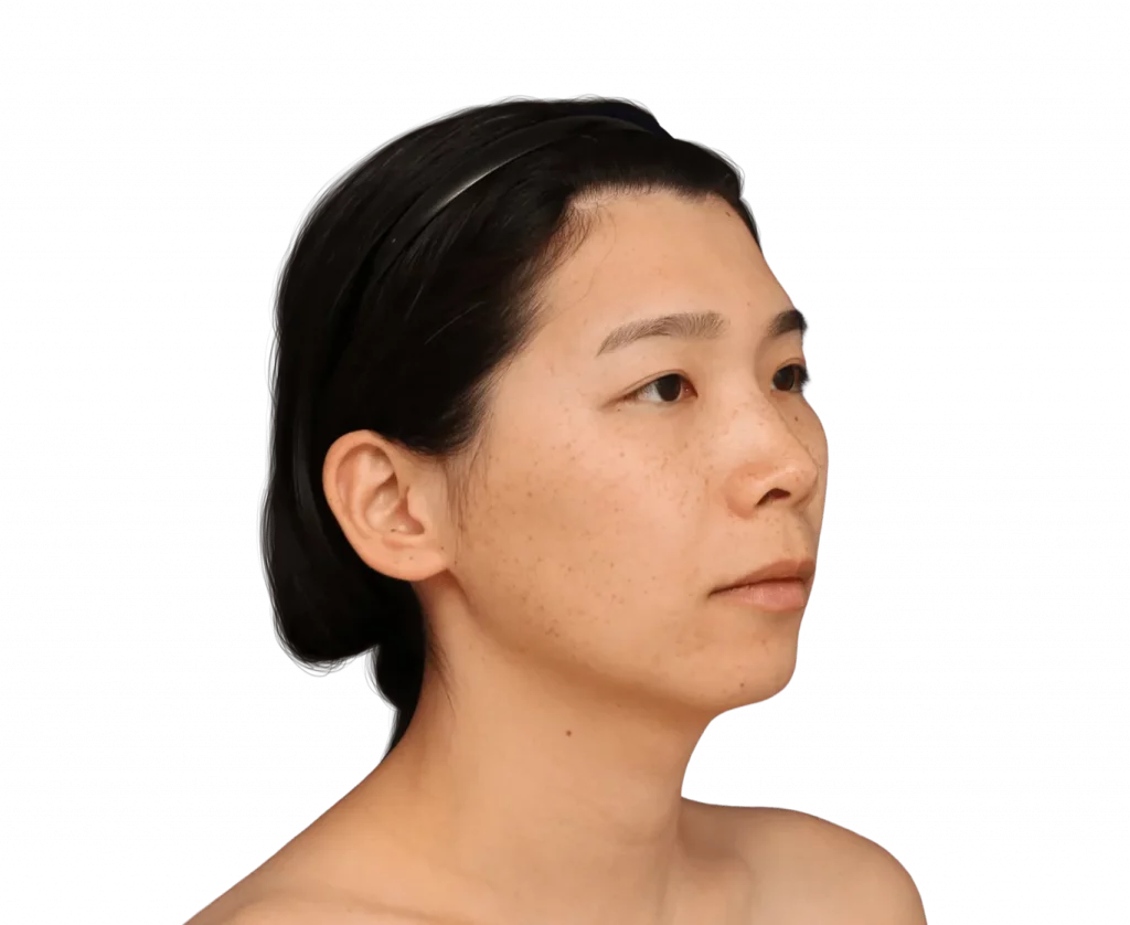 harriet-before-3-4 — Facialteam Picture taken at a 45 degree angle from Harriet before surgery