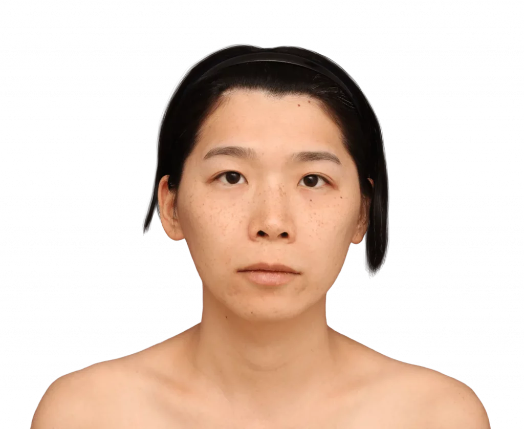 harriet-before-front — Facialteam Frontal picture taken from Harriet before surgery