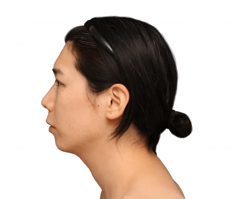 harriet-before-left-side — Facialteam Picture taken from the left side of Harriet before surgery