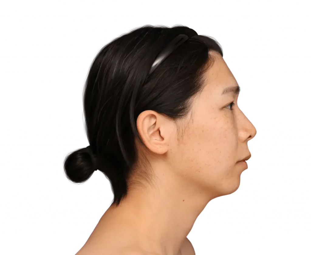 harriet-before-side — Facialteam Picture taken from the side of Harriet before surgery