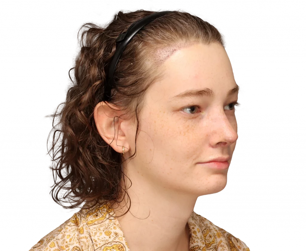 Alina-After-3-4 — Facialteam