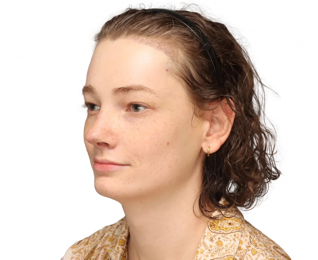 Alina-After-3-4-Left — Facialteam