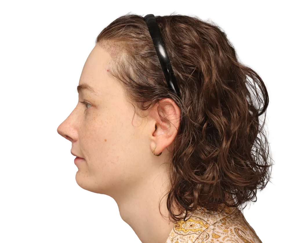Alina-After-Left — Facialteam