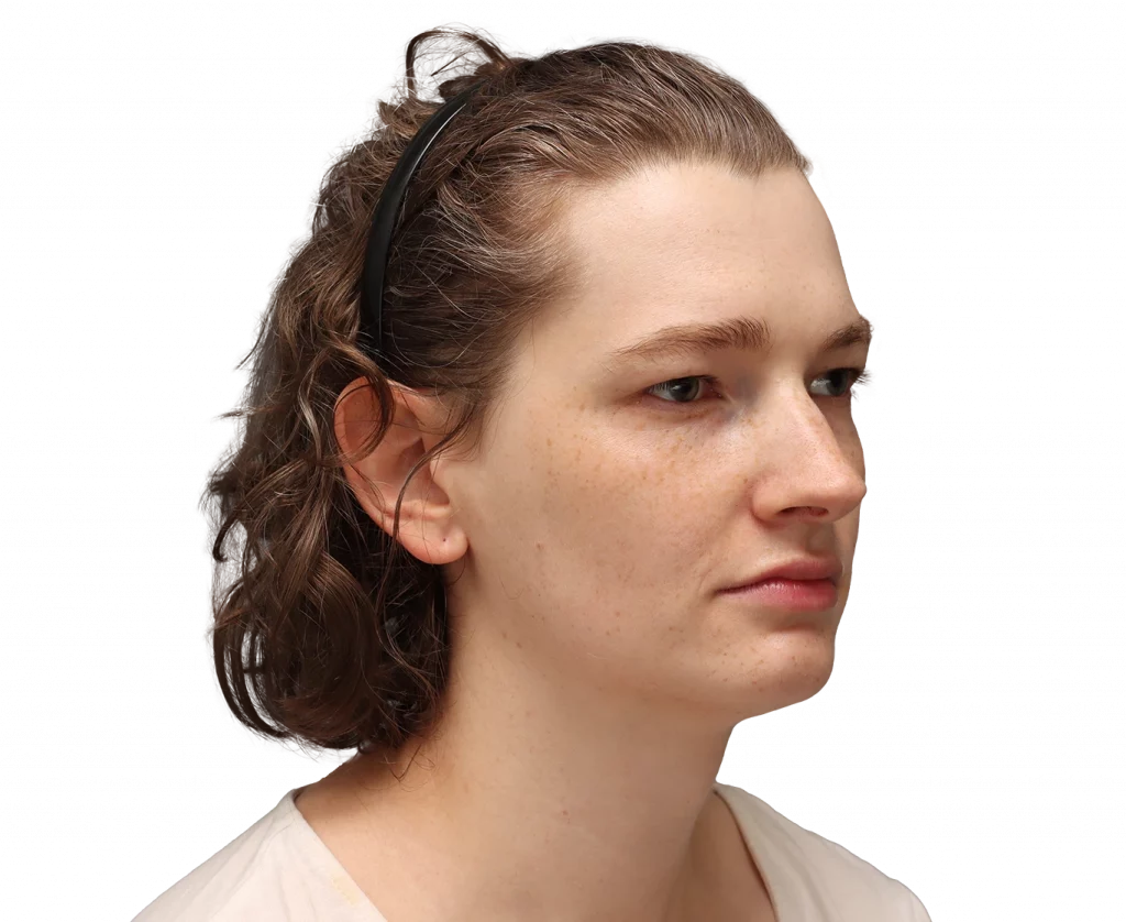 Alina-Before-3-4 — Facialteam