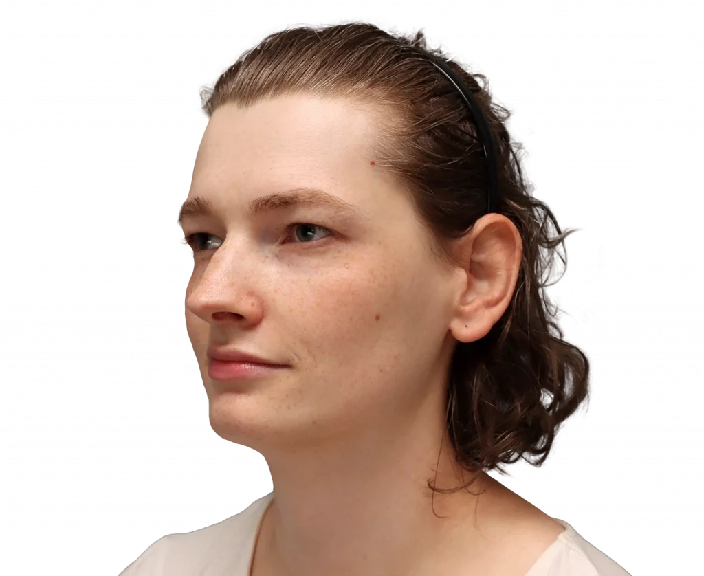 Alina-Before-3-4-Left — Facialteam