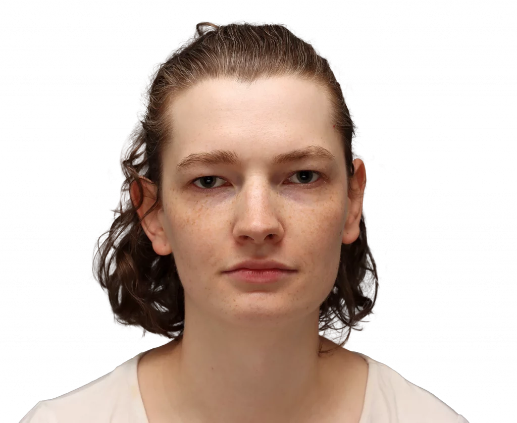 Alina-Before-Front — Facialteam