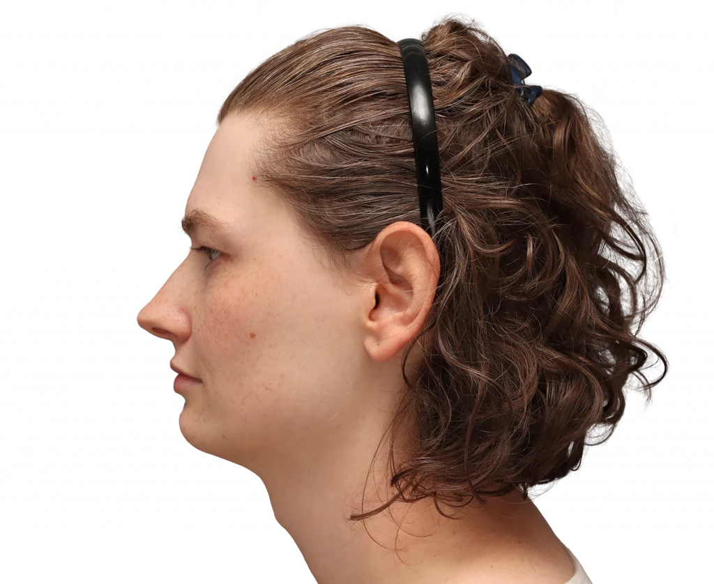 Alina-Before-Left — Facialteam