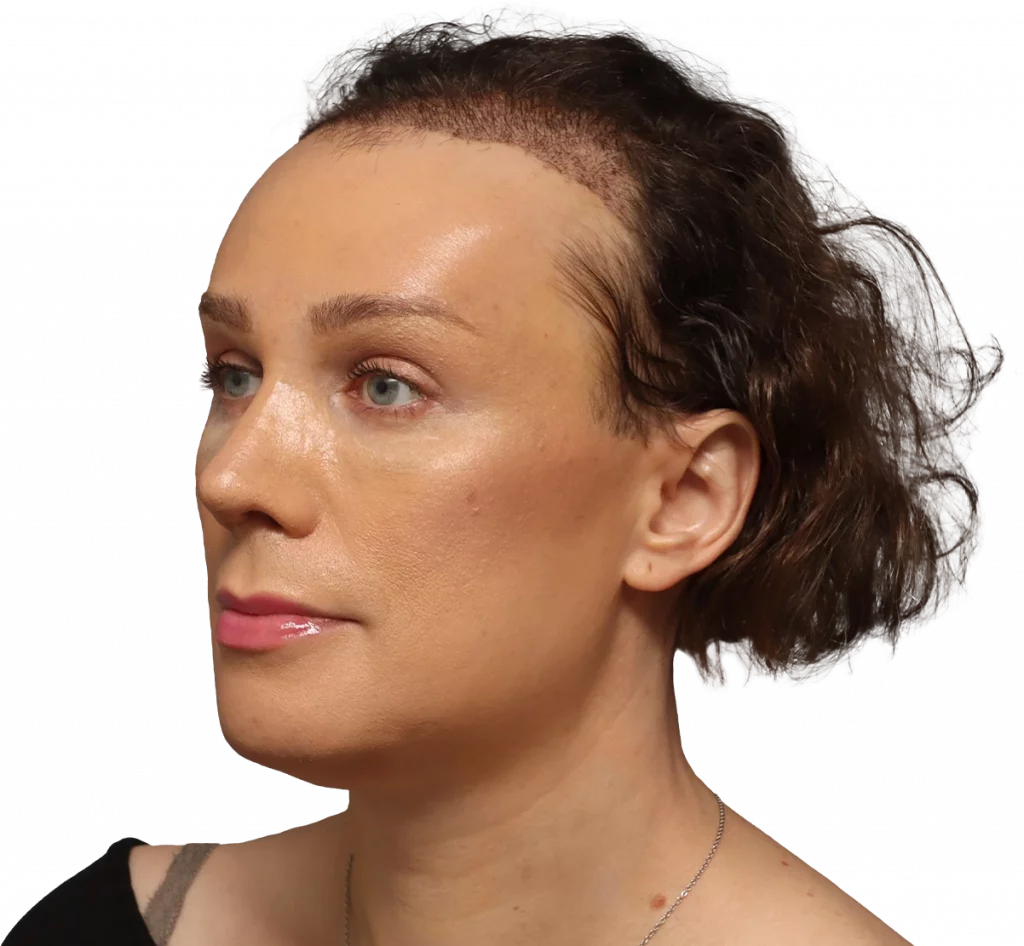 Lucia-After-3-4 — Facialteam