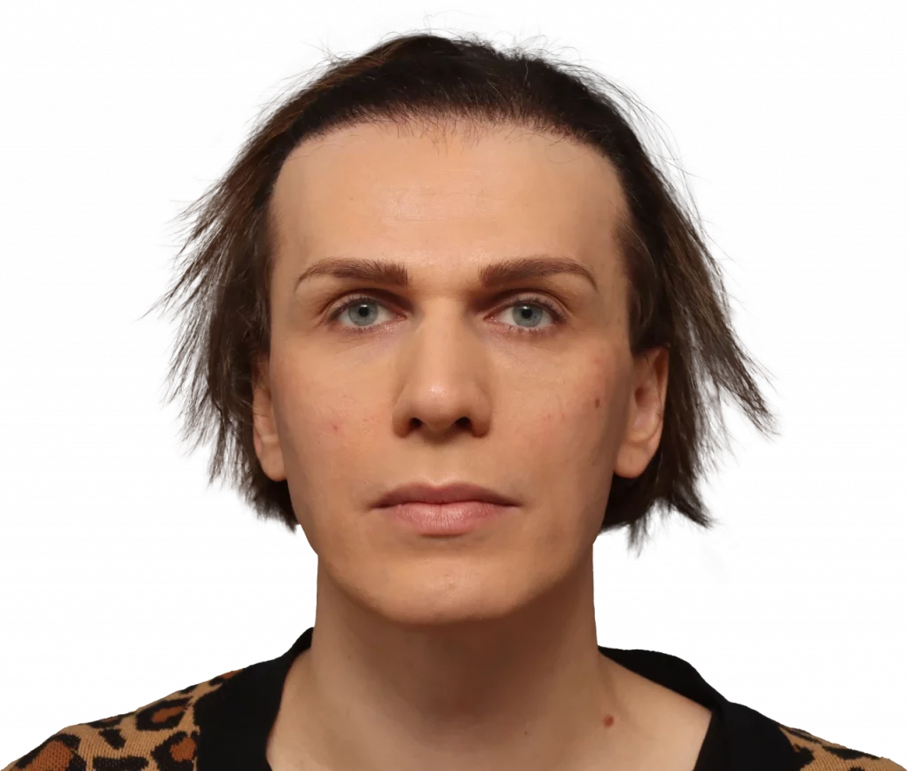 Lucia-After-Front — Facialteam