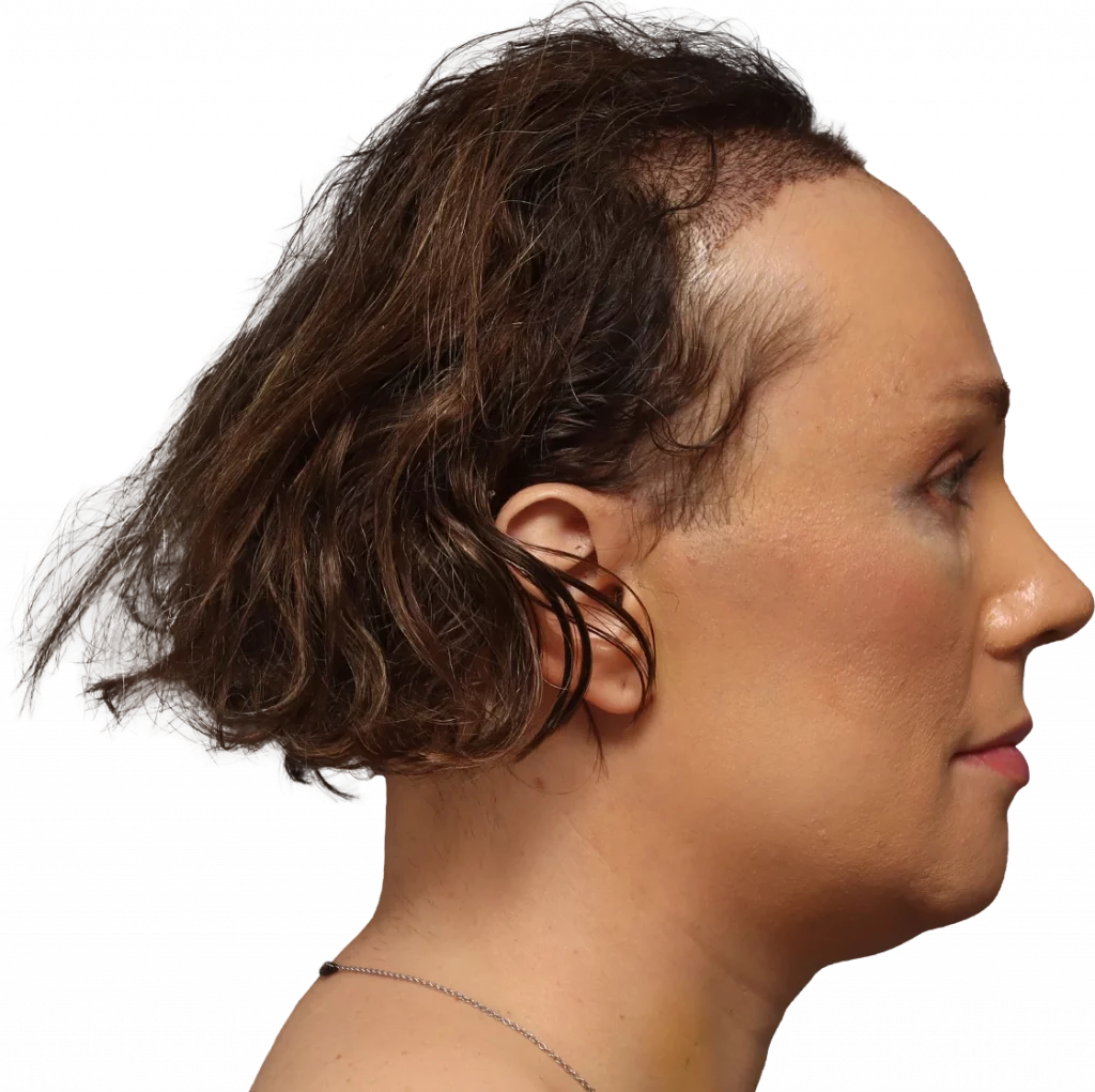 Lucia-After-Right — Facialteam