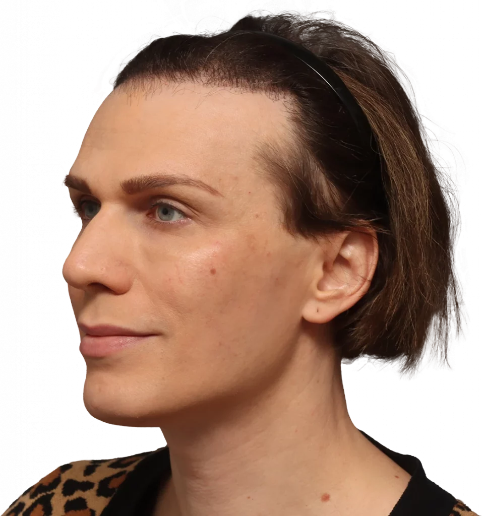 Lucia-Before-3-4 — Facialteam
