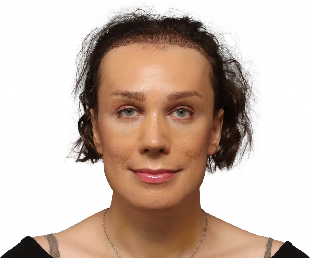 Lucia-Before-Front — Facialteam