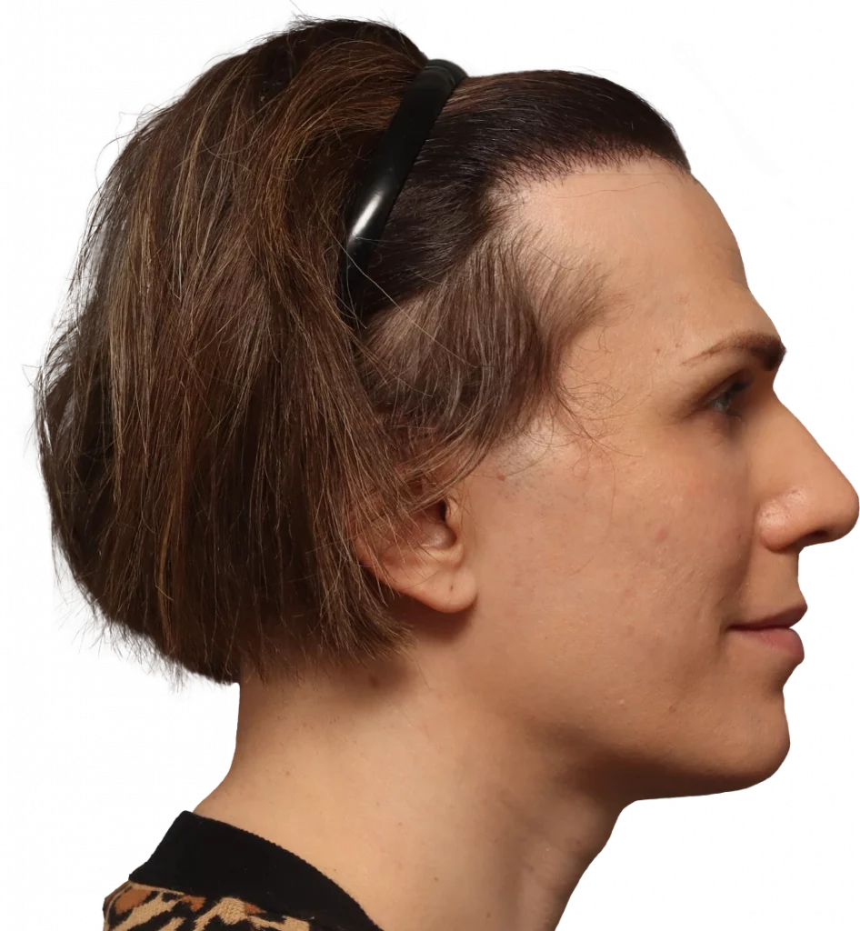 Lucia-Before-Right — Facialteam