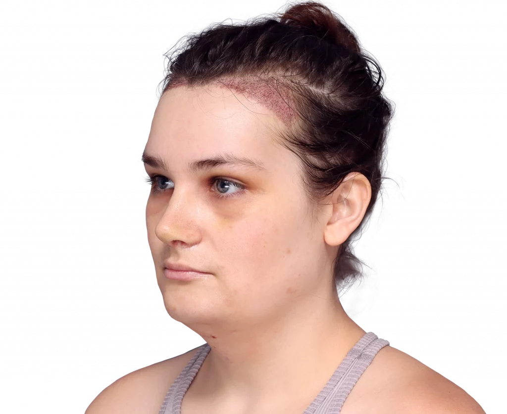 alex-after-3-4-left — Facialteam
