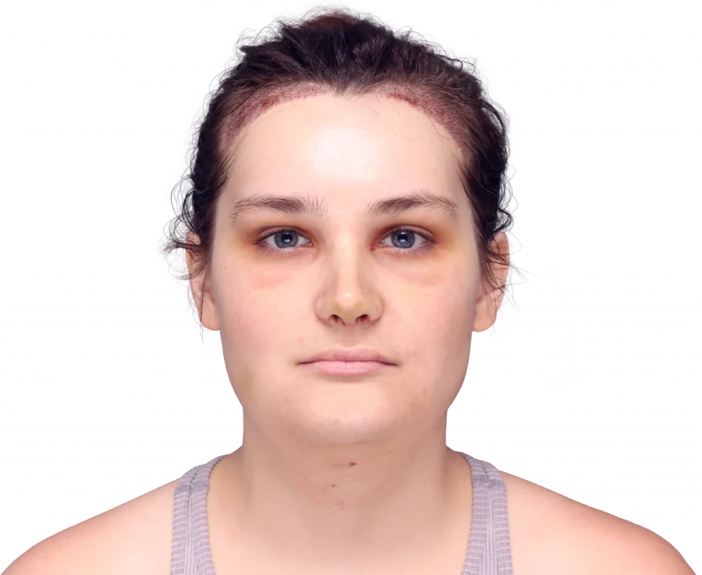 alex-after-front — Facialteam