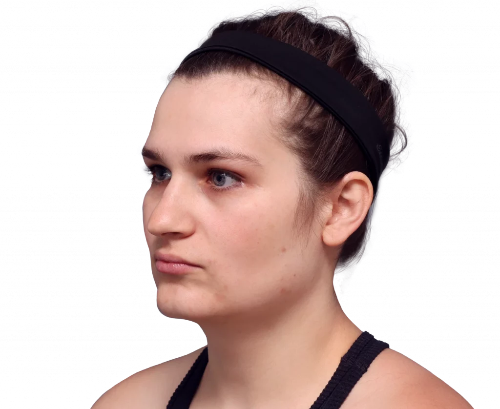 alex-before-3-4-left — Facialteam