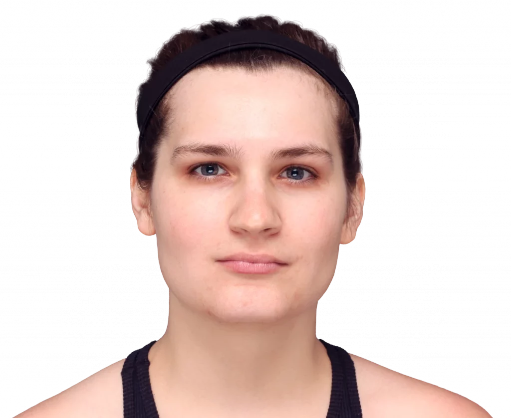 alex-before-front — Facialteam