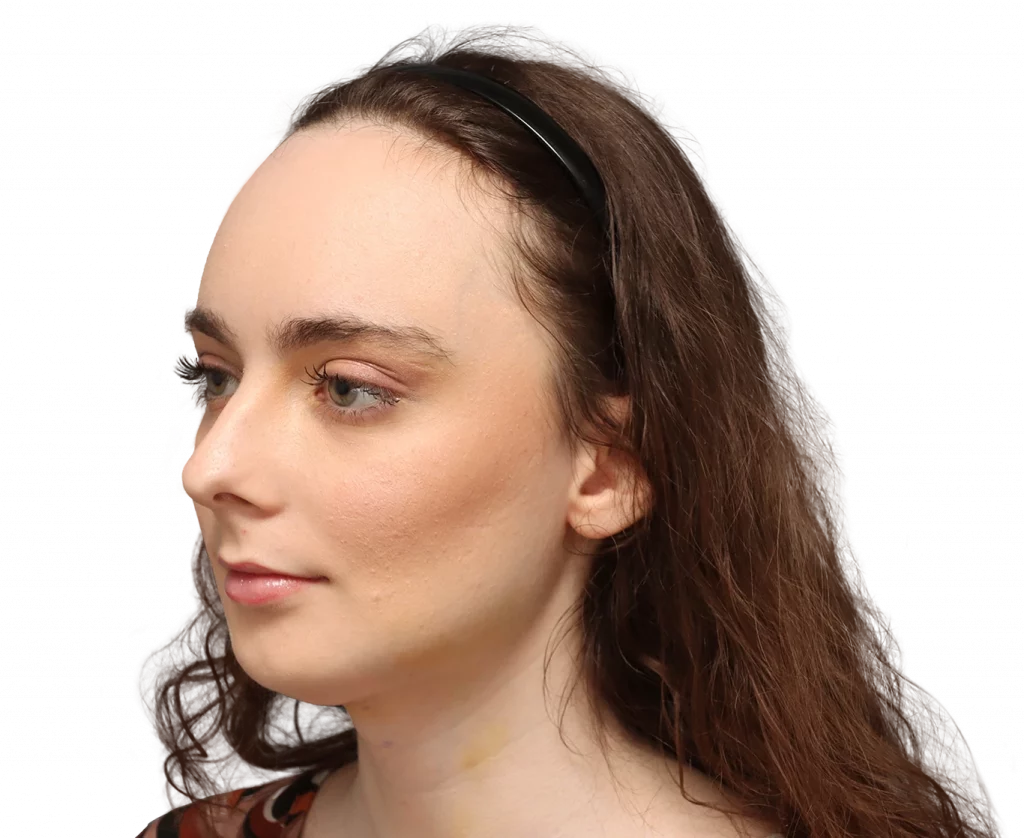 Linke Profilansicht in Schrägaufnahme von Alex M nach der Operation.