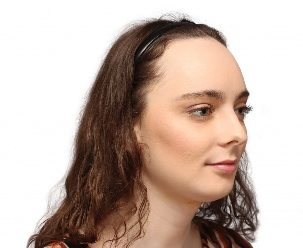 Rechte Profilansicht in Schrägaufnahme von Alex M nach der Operation.