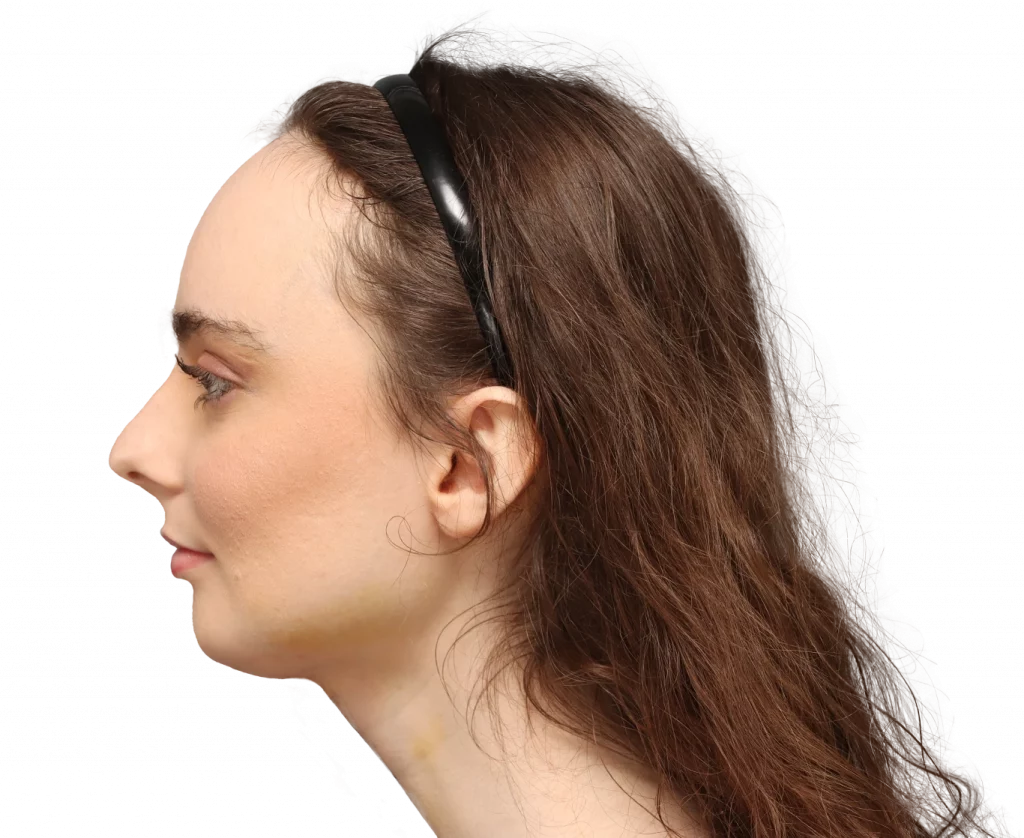 Linke Profilaufnahme von Alex M nach der Operation.