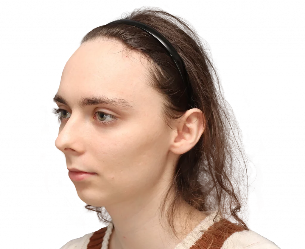 Linke Profilansicht in Schrägaufnahme von Alex M vor der Operation.