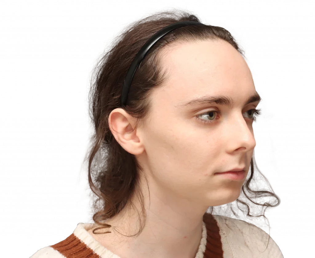 Rechte Profilansicht in Schrägaufnahme von Alex M von der Operation.