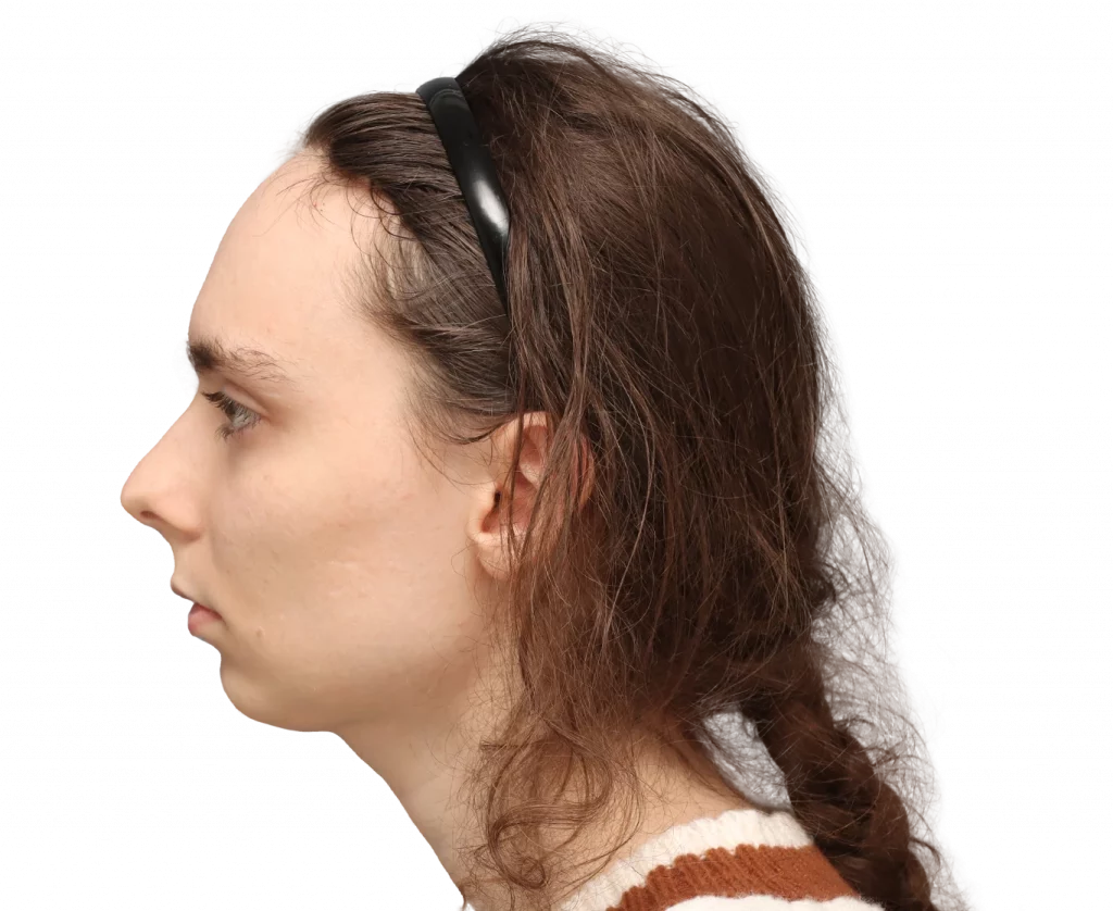 Linke Profilaufnahme von Alex M von der Operation.