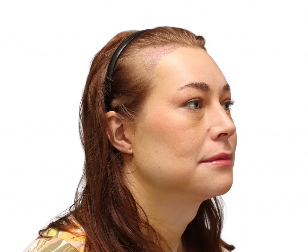 Rechte Profilansicht in Schrägaufnahme von Juuli nach der Operation.