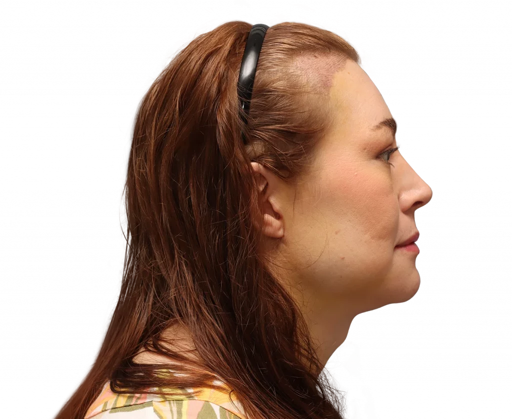 Rechte Profilaufnahme von Juuli nach der Operation.