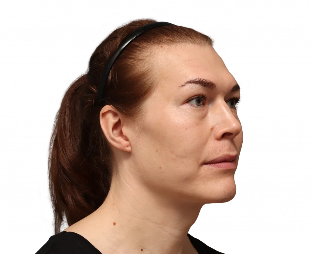 Rechte Profilansicht in Schrägaufnahme von Juuli vor der Operation.