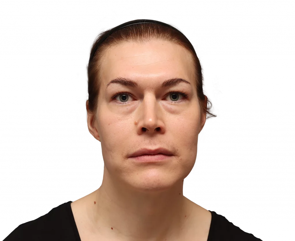 Frontale Profilaufnahme von Juuli vor der Operation.