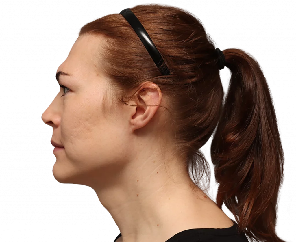 Linke Profilaufnahme von Juuli vor der Operation.