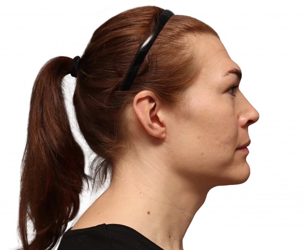 Rechte Profilaufnahme von Juuli vor der Operation.