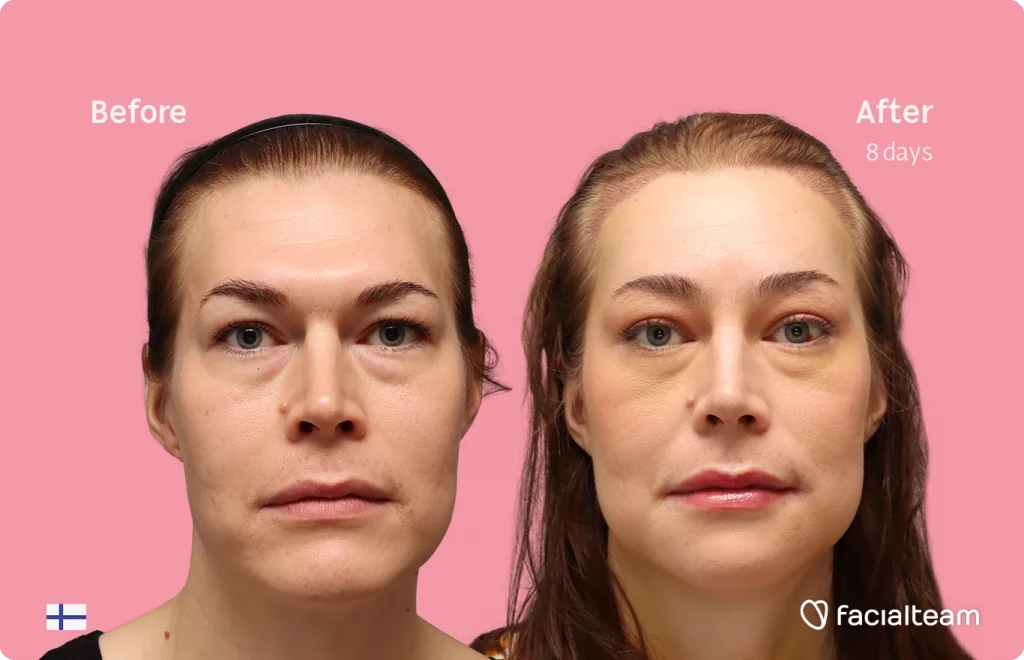 Frontaufnahme von Juuli, die ihre Vorher-Nachher-Transformation der FFS mit Facialteam zeigt: Stirn mit SHT, Kinn und Kiefer, mit HIFU als ergänzendem Eingriff.