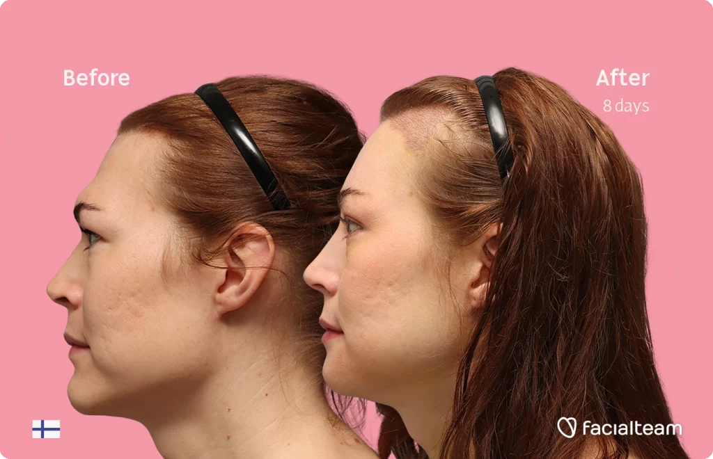 Seitenansicht (linkes Profil) von Juuli, die ihre Vorher-Nachher-Transformation der FFS mit Facialteam zeigt: Stirn mit SHT, Kinn und Kiefer, mit HIFU als ergänzendem Eingriff.