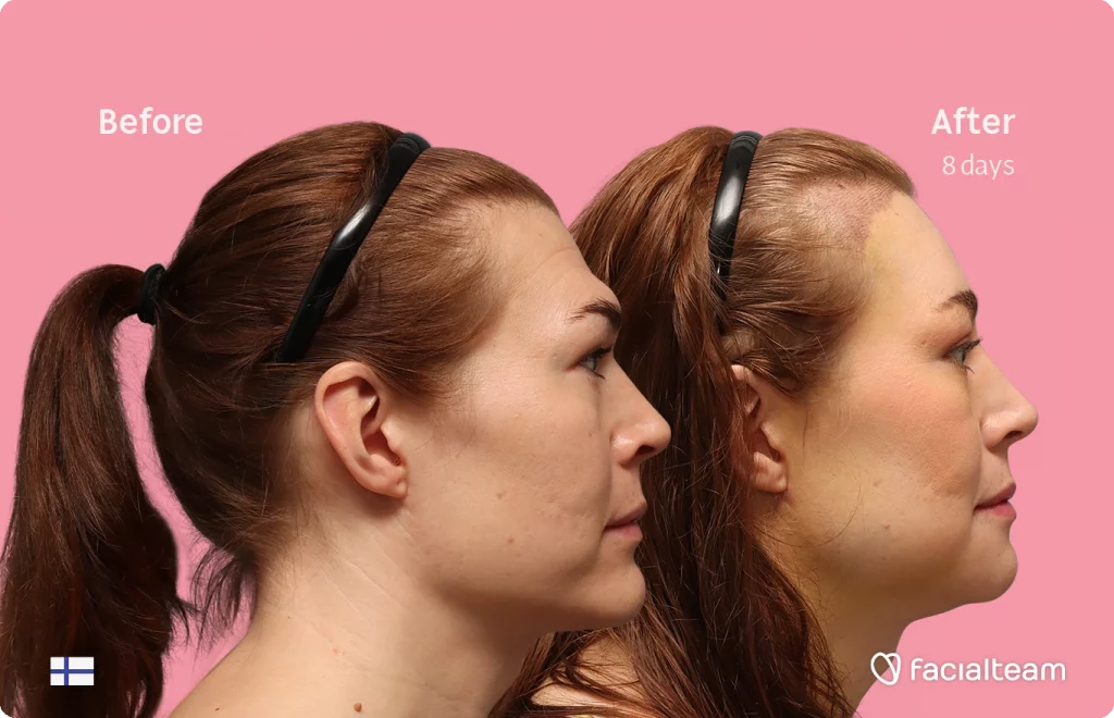 Seitenansicht (rechtes Profil) von Juuli, die ihre Vorher-Nachher-Transformation der FFS mit Facialteam zeigt: Stirn mit SHT, Kinn und Kiefer, mit HIFU als ergänzendem Eingriff.