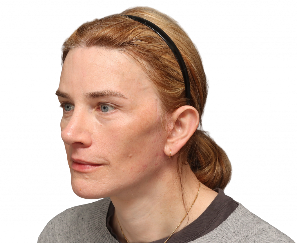 Linke Profilansicht in Schrägaufnahme von Nina S nach der Operation.