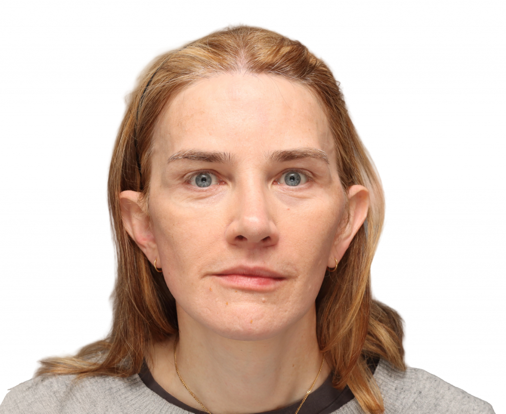 Frontansicht von Nina S nach der Operation.