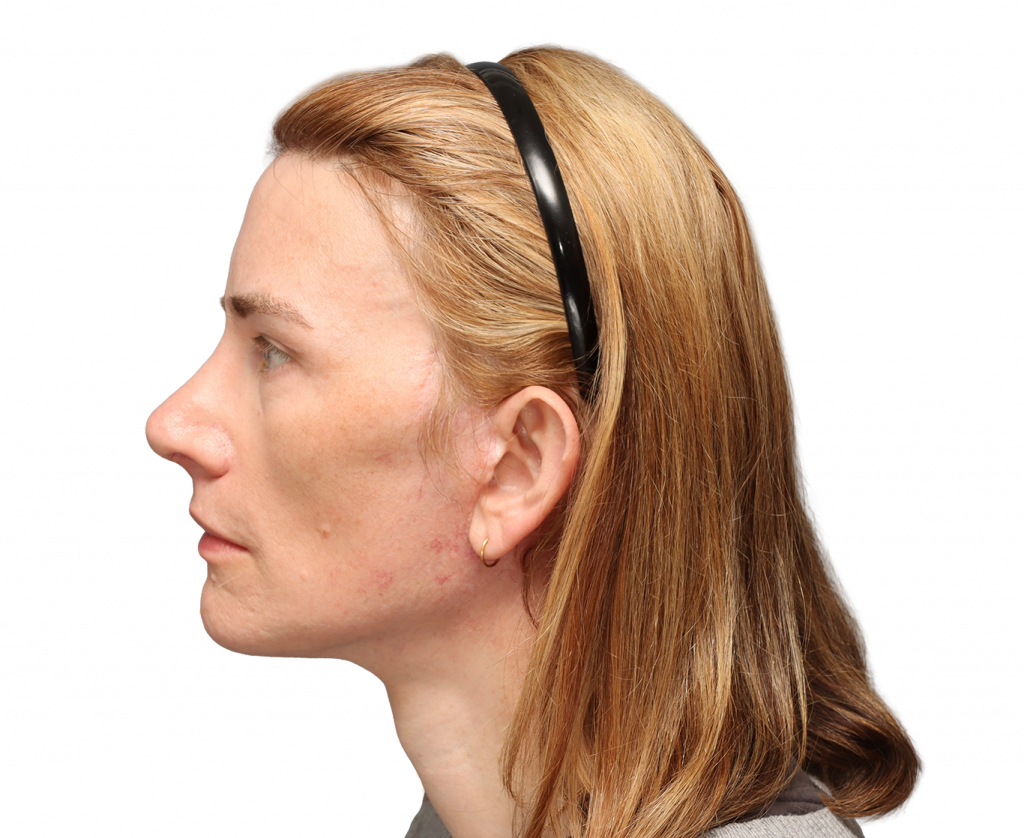 Linke Profilaufnahme von Nina S nach der Operation.