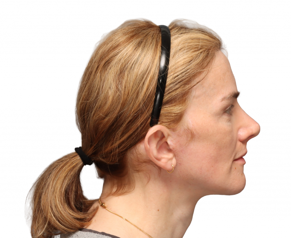 Rechte Profilaufnahme von Nina S nach der Operation.