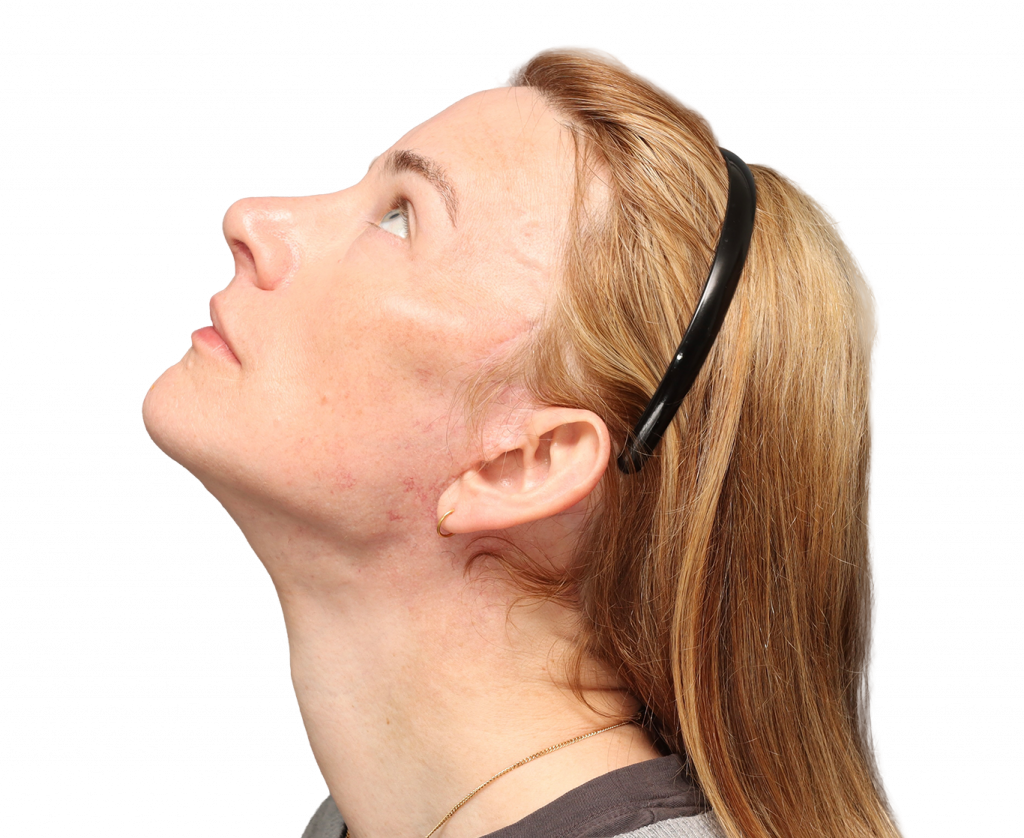 Linke Profilaufnahme aus leicht erhöhter Perspektive von Nina S nach der Operation.