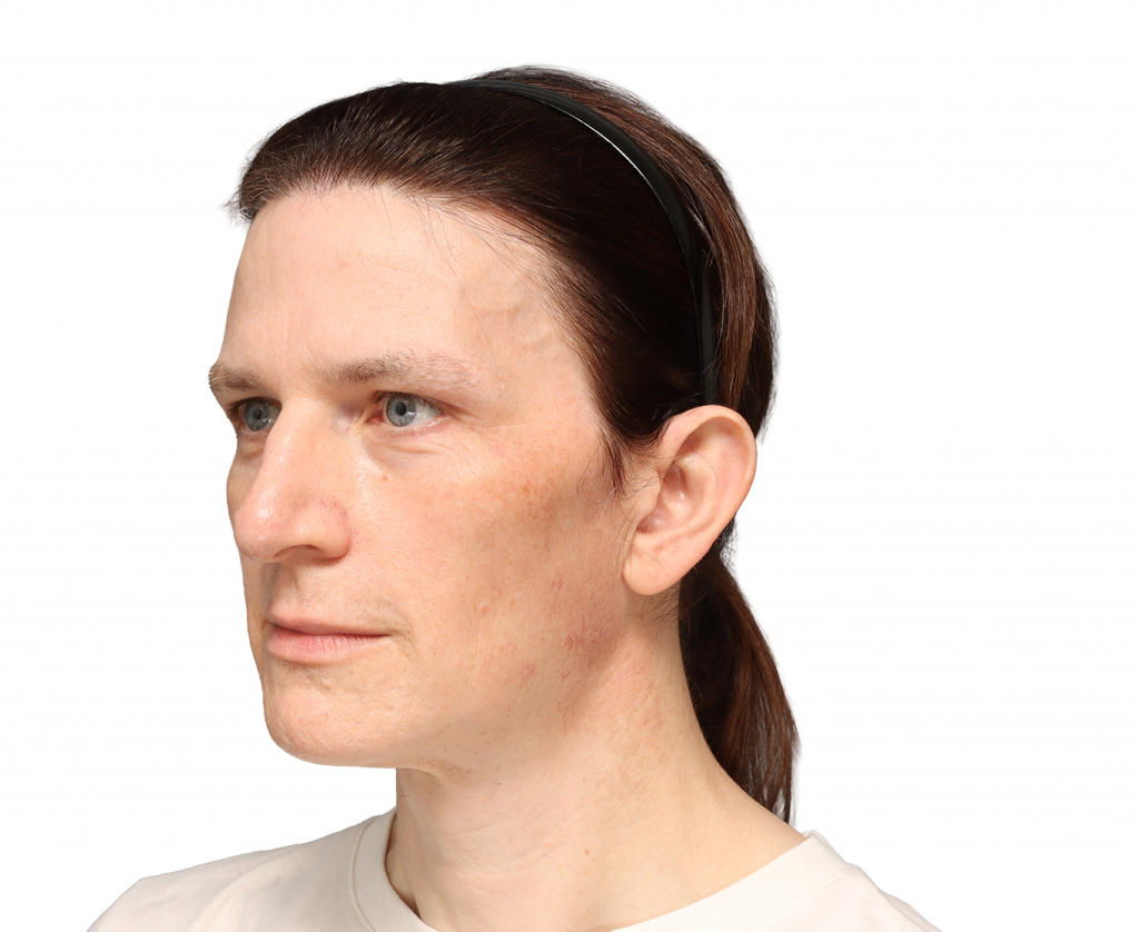 Linke Profilansicht in Schrägaufnahme von Nina S von der Operation.