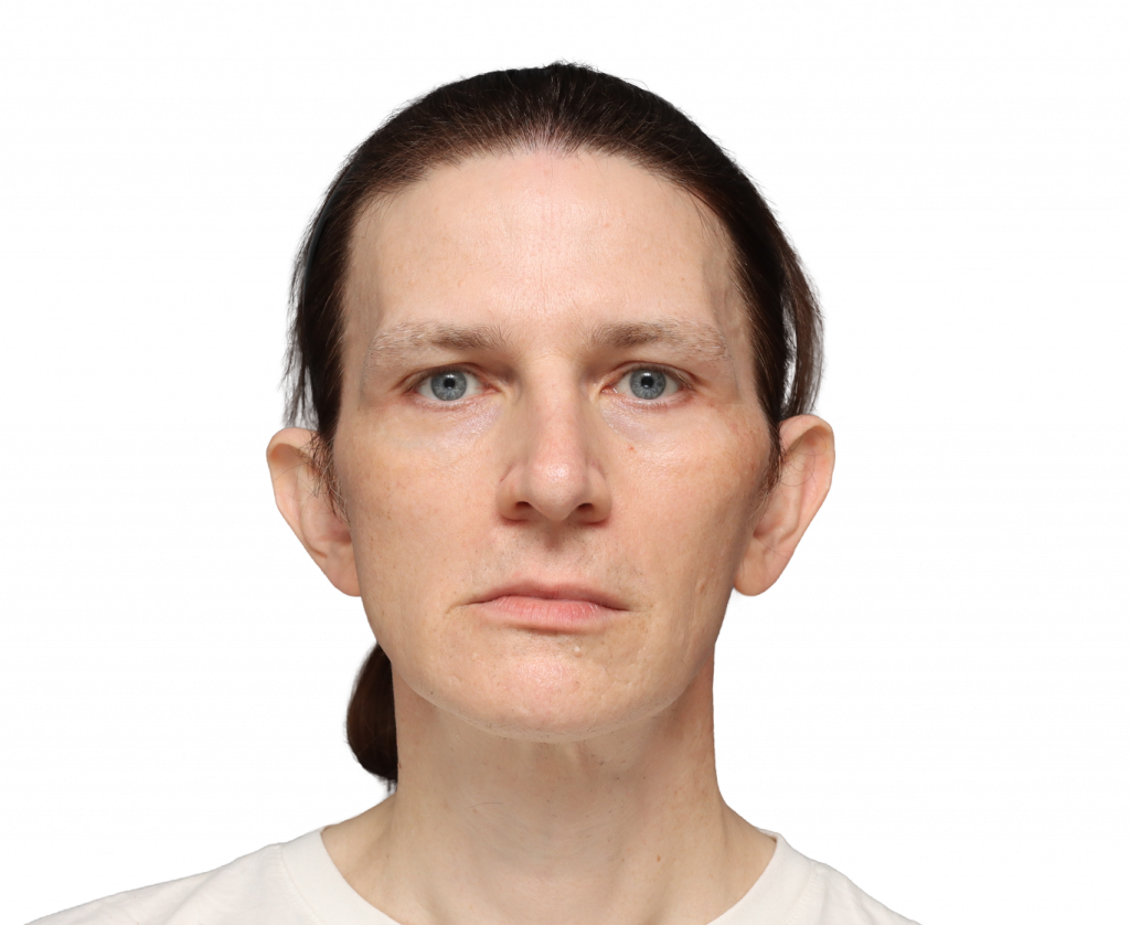 Frontansicht von Nina S von der Operation.