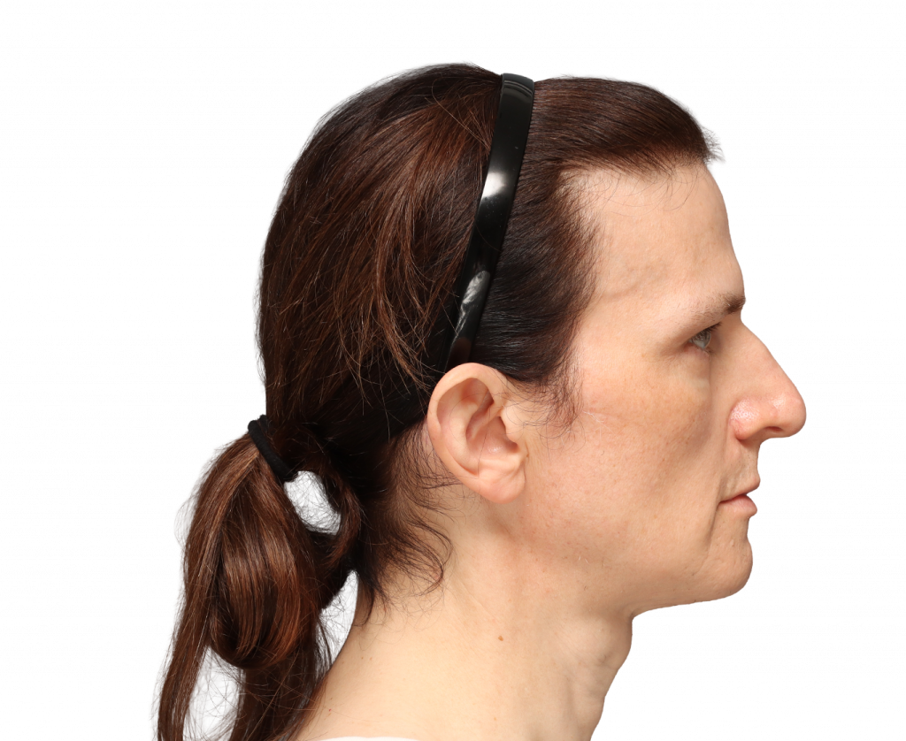 Rechte Profilaufnahme von Nina S von der Operation.