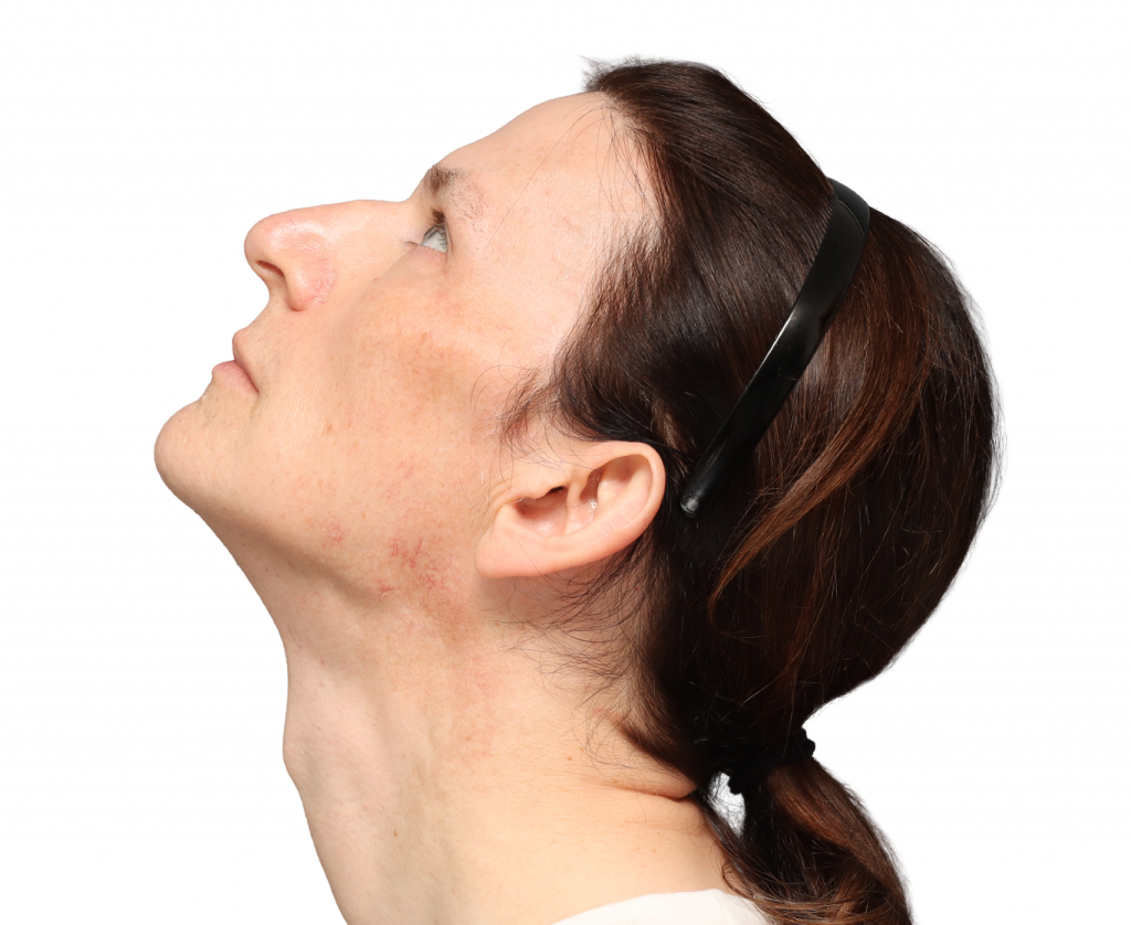 Linke Profilaufnahme aus leicht erhöhter Perspektive von Nina S von der Operation.