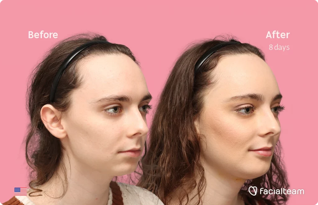 Schrägaufnahme des rechten Profils der FFS-Patientin Alex M, die die Vorher-Nachher-Ergebnisse mit Facialteam zeigt, einschließlich Stirnfeminisierung, Kinnfeminisierung und Adamsapfelreduktion.